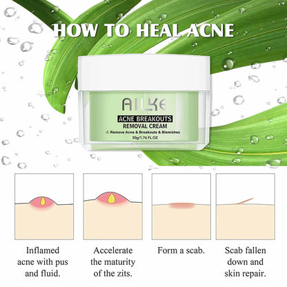 Acne Breakouts Removal Cream